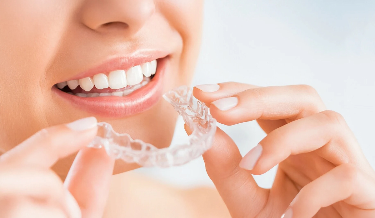 clear-aligners
