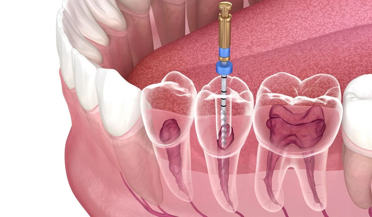 painless-root-canal-treatmenty