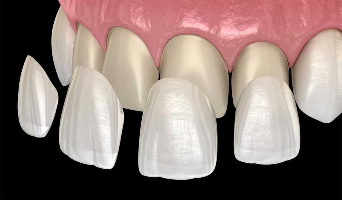 veneers-and-laminates